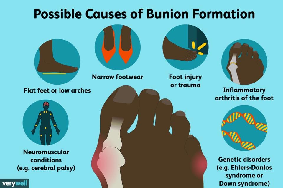 ACTIGUARD Bunion Splint - Asian Integrated Medical Sdn Bhd (ielder.asia)